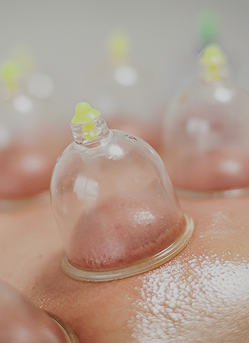 Cupping